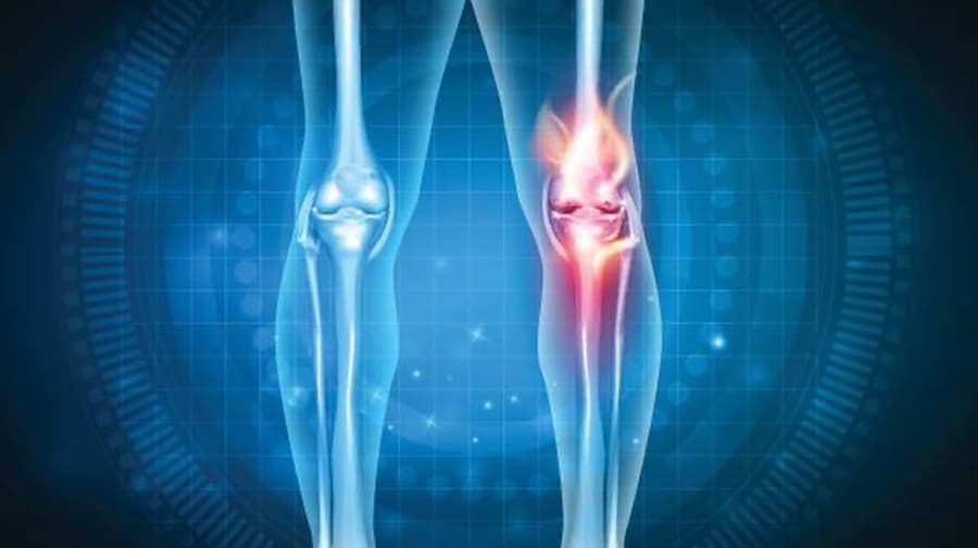 Avances de la medicina Regenerativa en la osteoartritis de rodilla